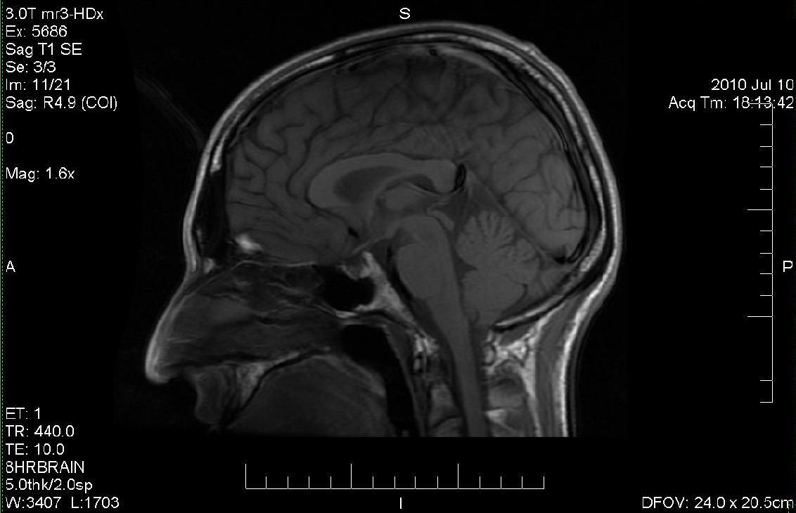 קרוב להפליא רועש להחריד – סריקת מוח ב-fMRI 1